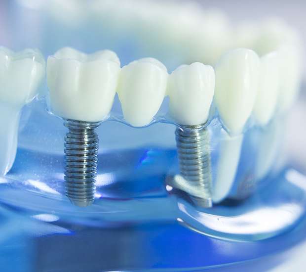 Ejemplo de implantes dentales